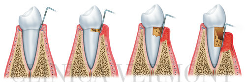 Gingivitis Clínica Vermont