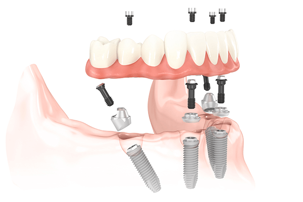 Clinica_de_implantes_dentales_all_on_4_madrid