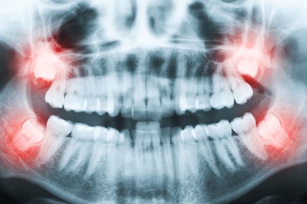 Implantes_dentales_cordales_muelas_juicio_madrid-1