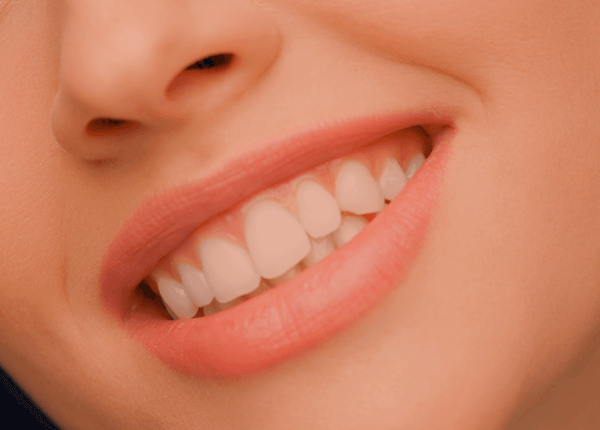gingivectomia