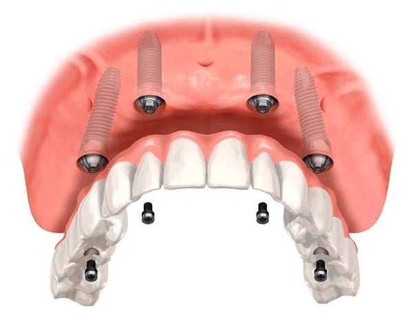implantes-dentales-carga-inmediata