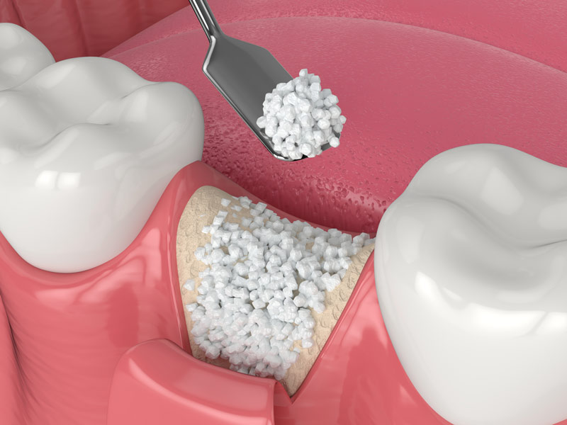 implantes-dentales-injertos-oseos
