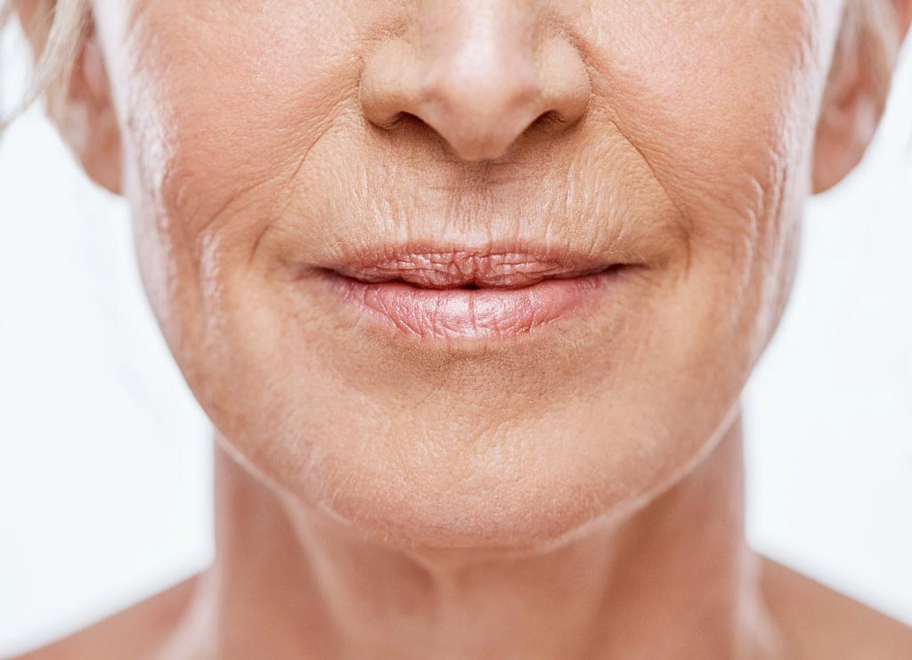 tratamiento-area-perioral-clinica-estetica