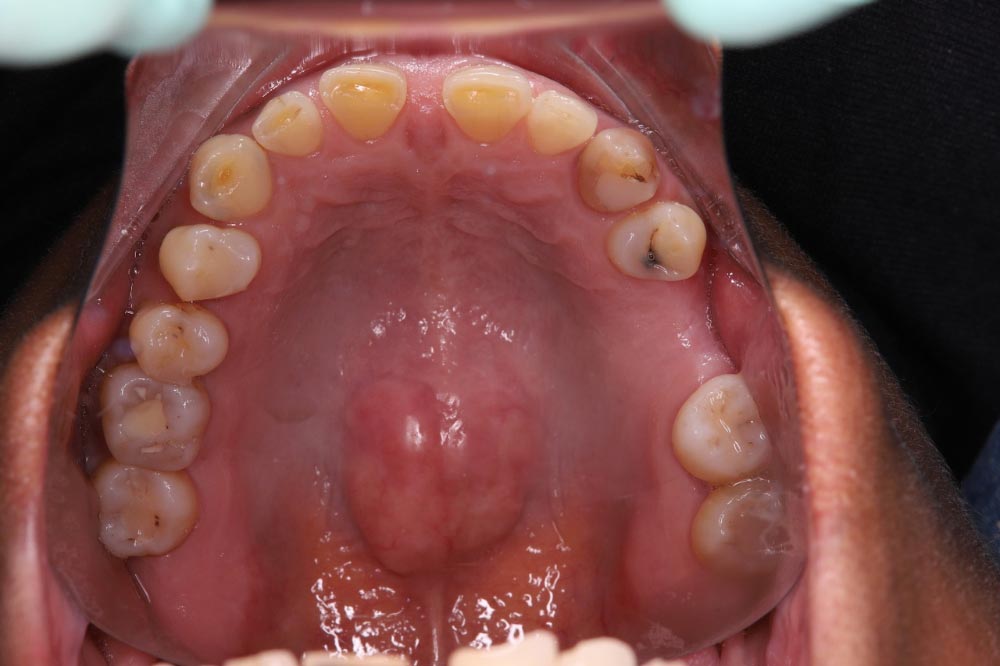 caries-dentales-tratamiento-chamartin
