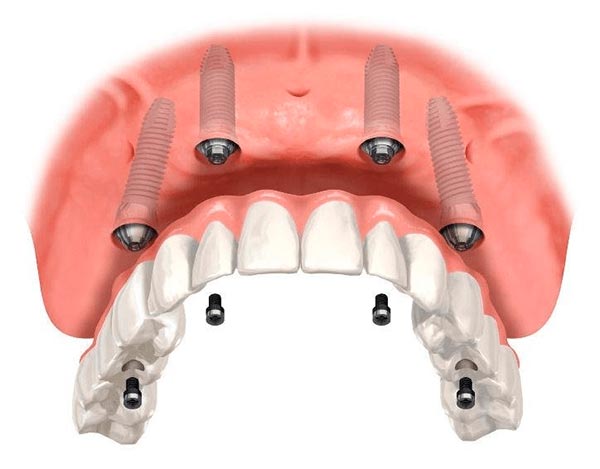 clinica dental chamartin tratamiento caries dentales