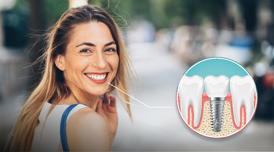 implantes-dentales-cuidados-evitar-consecuencias-negativas