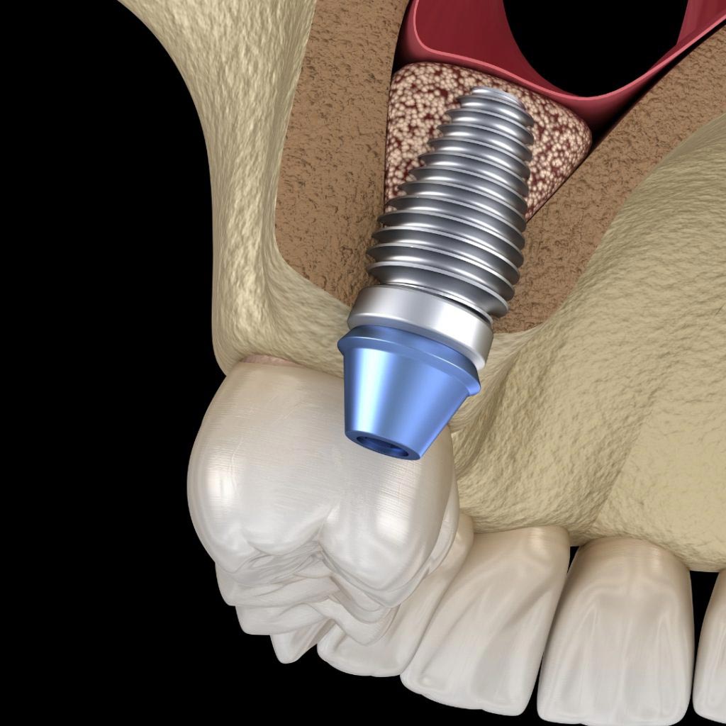 clinica dental elevacion seno