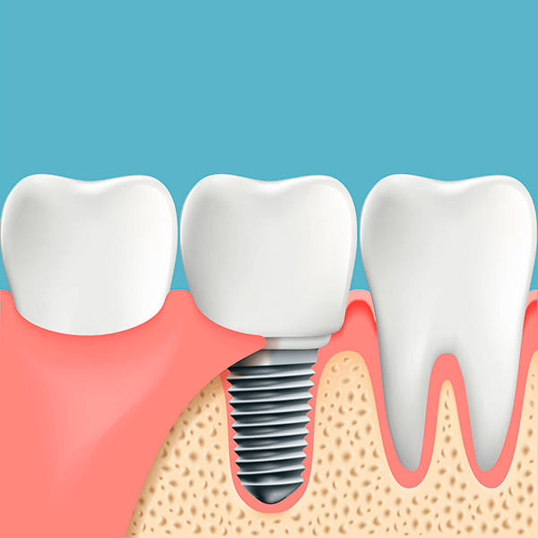 Clinicas Implantes Dentales en Madrid