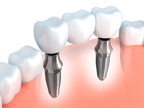 Implantes Dentales sin Cirugia Madrid