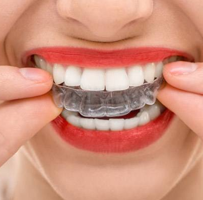 Blanqueamiento Dental Tipos