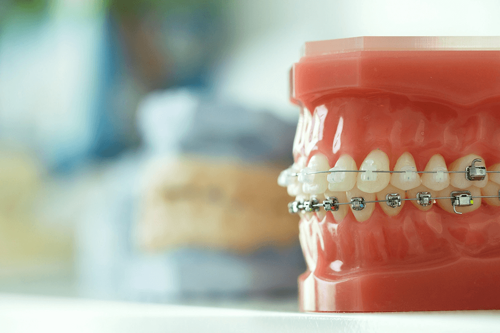 Estetica Dental Ortodoncia Estetica Madrid