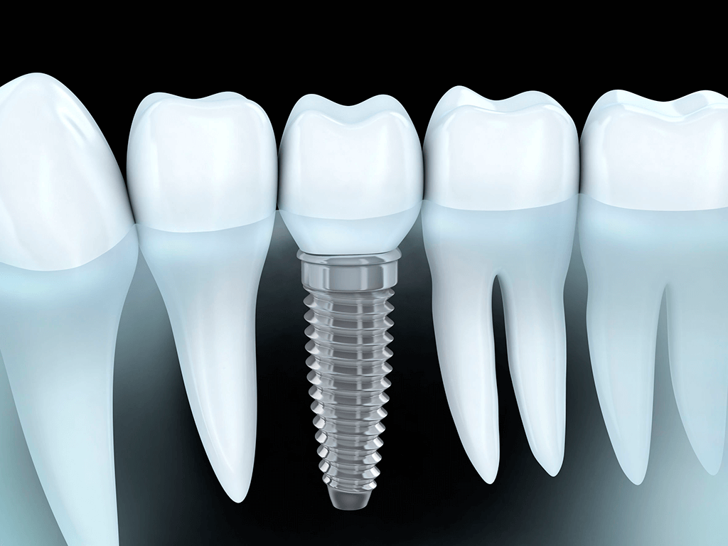 Odontología Implantes dentales