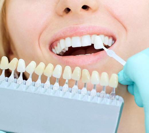 Tratamiento Blanqueamiento Dental en Madrid